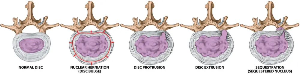 Evolution dégénérative d'un disque intervertébral