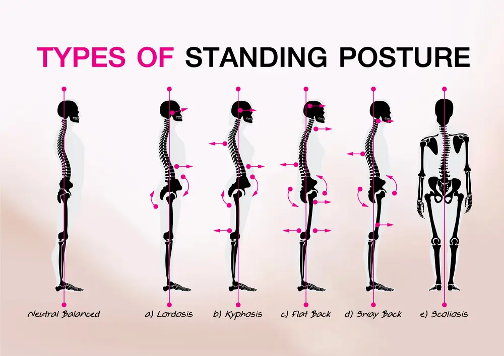 Postures statiques normale et pathologiques