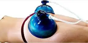 vacuum thérapie pour pompage de la fesse Vacuum thérapie pour fessiers