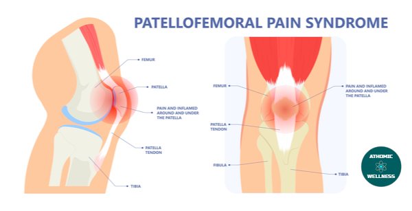 syndrome femoro-patellaire